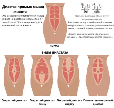 Диастаз прямых мышц живота: симптомы, лечение в Юсуповской больнице в Москве