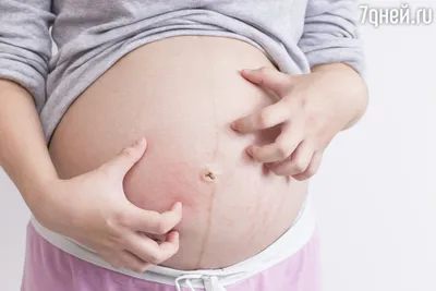 Румяные» щечки: как лечить диатез у новорожденного ребенка - 7Дней.ру