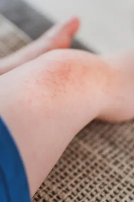 Пищевая аллергия экзема или диатез у маленького ребенка на ногах | Премиум  Фото
