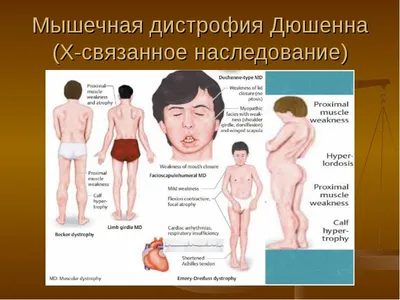 Мышечная дистрофия Дюшенна | Справка.Неинвалид.ru