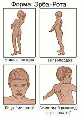 Виды и симптомы мышечной дистрофии | Обучение реабилитации МАМР | Дзен