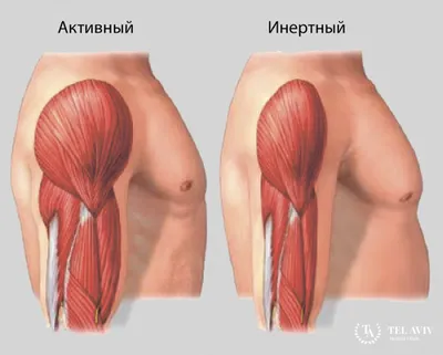 Миотоническая дистрофия (МД)