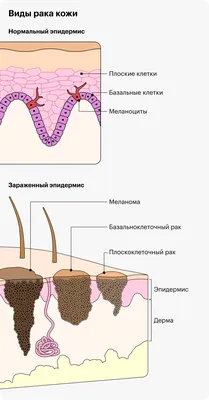 Узловая меланома кожи: как выглядит, симптомы и стадии, как быстро  развивается, статистика | Клиники «Евроонко»