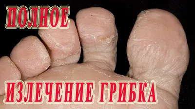 Грибок между пальцами ног: лечение, препараты, мази