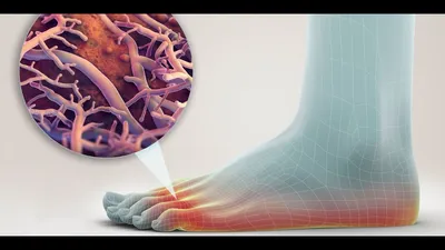 Грибок нігтів на ногах - фото, симптоми, ознаки і лікування