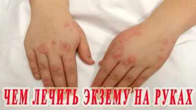 ☆ How to treat eczema on the hands (weeping shingles). Drug therapy. -  YouTube