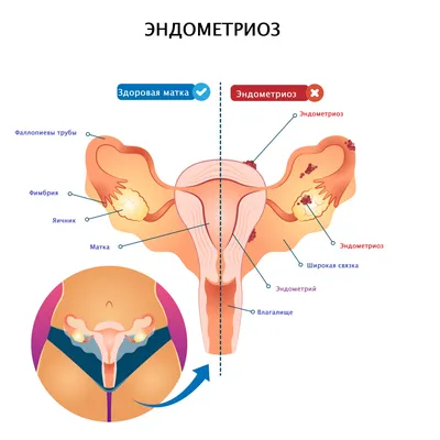 Эндометриоз фото