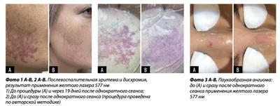 Лазерная коррекция сосудистых патологий и пигментации