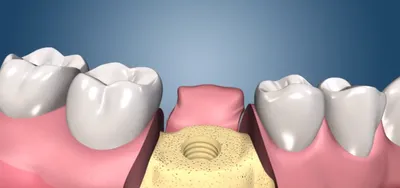 Как ставят зубные импланты: этапы и сроки установки пошагово с фото и видео