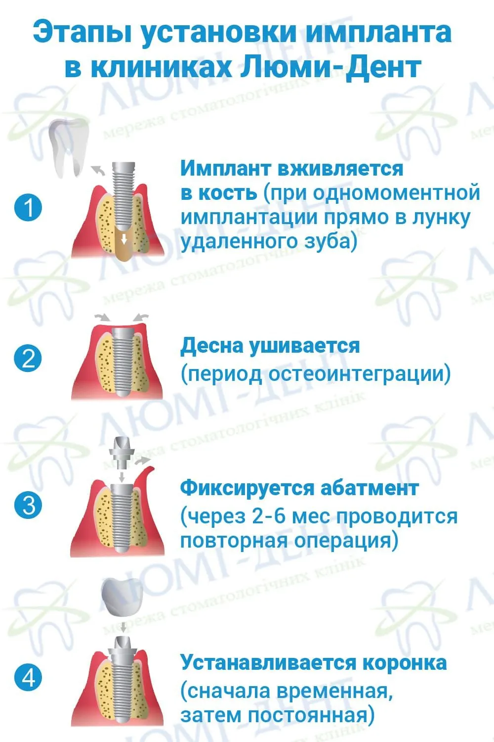 Пошагово как ставить импланты. Этапы установления импланта зуба. Имплантирование зубов этапы установки. Схема постановки импланта. Этапы при имплантации зубов.