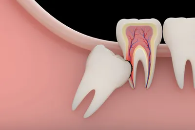 Рекомендации после удаления зуба - восстановление после удаления зубов  мудрости