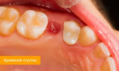 Белый налет на десне после удаления зуба — что означает налет на ране в  лунке после удаления зуба мудрости?