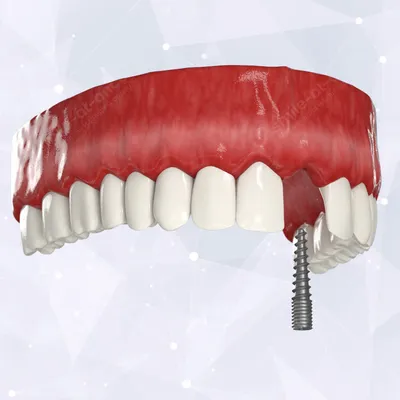 Удаление зуба в стоматологии в Москве, цена удаления зубных корней от 3 000  р в Smile-at-Once