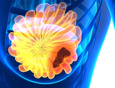 Фиброаденома — насколько опасна эта опухоль в груди | Evolutis Clinic | Дзен