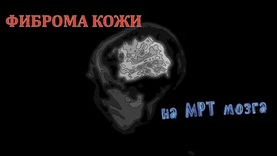 ФИБРОМА КОЖИ ГОЛОВЫ на расшифровке снимков МРТ головного мозга - YouTube