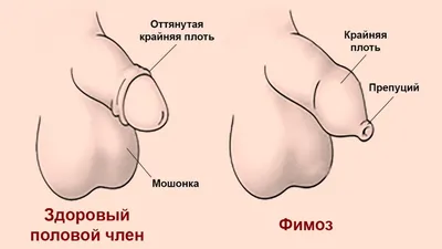 Фимоз у мужчин: лечение, причины, симптомы и диагностика. Урология