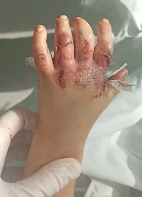 Челябинские травматологи сохранили двухлетнему малышу пальцы, почти  отрубленные мангалом | Pchela.news - Новости в Челябинске