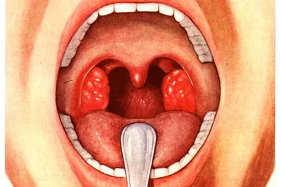 ДИФФЕРЕНЦИАЛЬНАЯ ДИАГНОСТИКА БОЛЕЙ В ГОРЛЕ