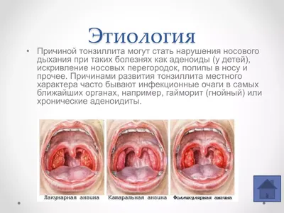 Как выглядит здоровое и больное красное горло у ребенка какими в норме  должны быть миндалины