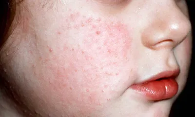 Фолликулярный кератоз кожи у ребенка: лечение