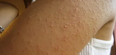 Гусиная кожа или дерматит?