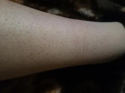 После эпиляции остаются красные точки на коже ног. Что делать?