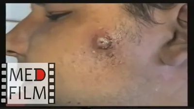 Furuncles and carbuncles of the face, abscess, hirudotherapy, leeches © -  YouTube