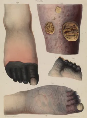 File:Plate II Mortification (gangrene), Robert Carswell 1830s Wellcome  L0074380.jpg - Wikimedia Commons