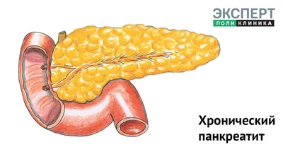 Хронический панкреатит / Заболевания / Клиника ЭКСПЕРТ