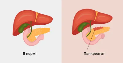 ⚕ Панкреатит: симптомы, причины лечение ➡ 【Киев】