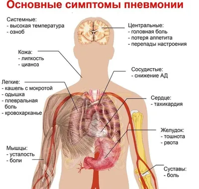 Пневмония - ГБУЗ СО «Новокуйбышевская центральная городская больница»