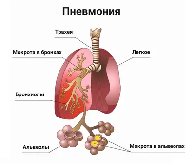 Пневмония - симптомы, признаки пневмонии у взрослых, лечение и профилактика