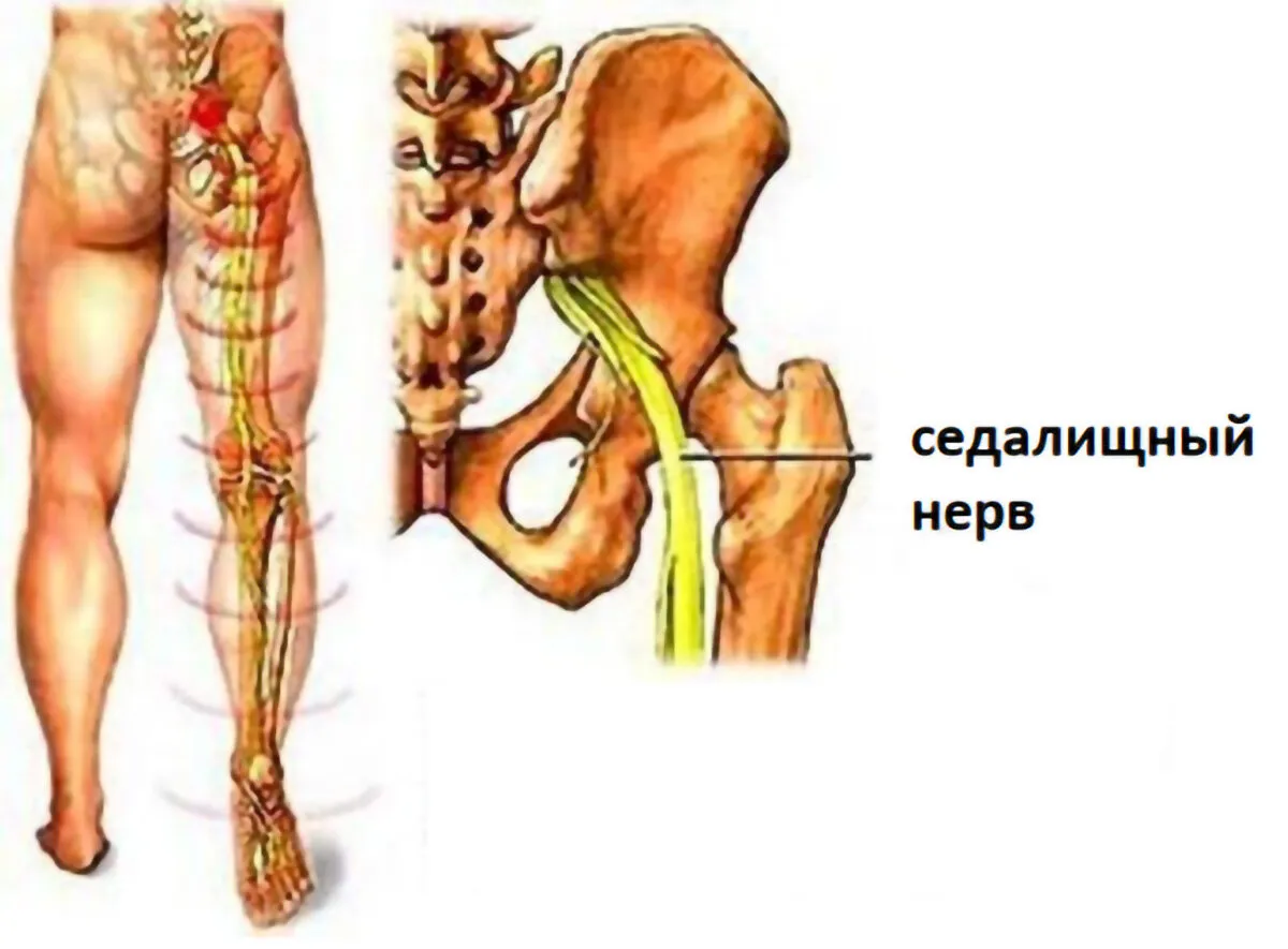 Седалищная невралгия симптомы и лечение