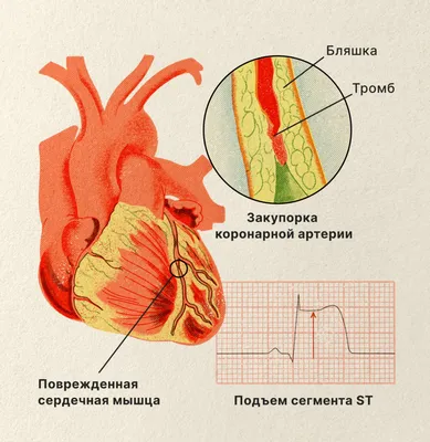 Ишемическая болезнь сердца: причины, патогенез, симптомы, диагностика,  лечение ИБС