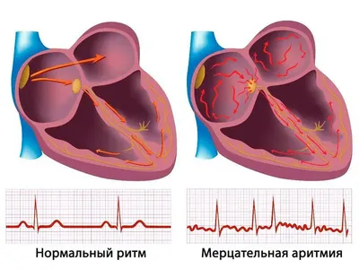 Приобретенные пороки сердца – диагностика и лечение в ФНКЦ ФМБА России