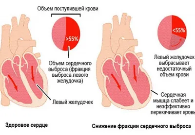 Тромболитическая терапия (тромболизис) на удалённых промышленных объектах —  Трудовая оборона