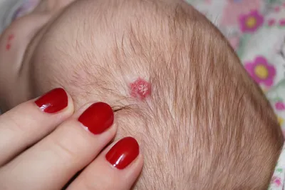 Лечение гемангиом Арутимолом 0,5% — HEMANGIOMA.PRO