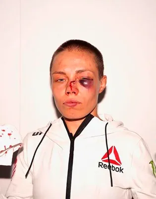 Гематома на лице девушки-бойца после турнира UFC испугала фанатов: Бокс и  ММА: Спорт: Lenta.ru