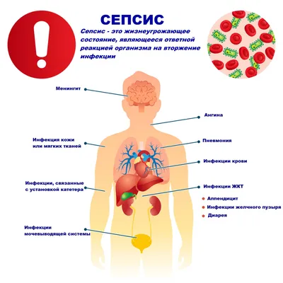 Сепсис - причины появления, симптомы и признаки заболевания, диагностика и  способы лечения, прогноз и последствия