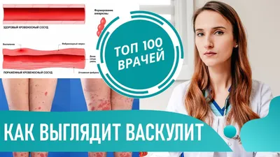 Что такое Васкулит (фото 1-8). Геморрагический васкулит кожи. Симптомы  васкулита на ногах - YouTube