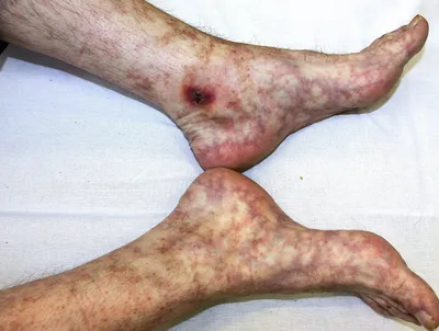 Сutaneous Vasculitis: Classification, Diagnosis and Differential Diagnosis  (Part 2) - Khairutdinov - Vestnik dermatologii i venerologii