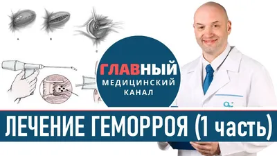 Как выглядит ГЕМОРРОЙ: фото 1-4 стадии. Симптомы геморроя у мужчин и женщин  - YouTube