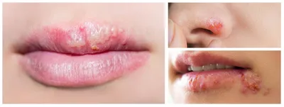 Что такое лабиальный герпес - причины появления и лечение герпеса  (простуды) на губах | Аллокин-Альфа