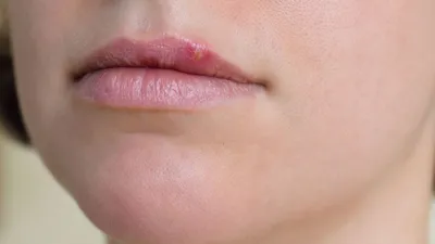 Герпес губ: причины, проявления, лечение