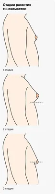 Гинекомастия (рост груди у мужчин): как ее диагностировать и что делать