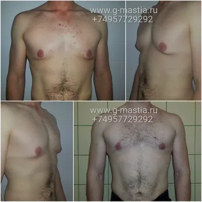 Подтяжка груди у мужчин после похудения
