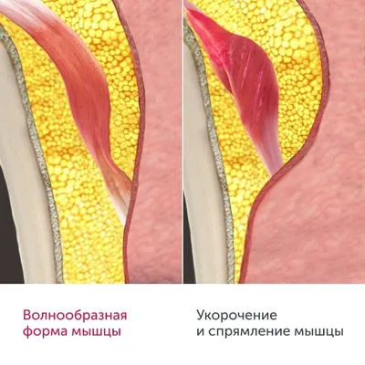 Юлия Массаж-Киев-Троещина - ГИПЕРТОНУС МЫШЦ КАК ПРИЧИНА ОБРАЗОВАНИЯ МОРЩИН.  Лицо - сложнейшая биомеханическая конструкция: на таком маленьком участке  как лицо и шея сосредоточено около 100 мышц, 29 костей черепа - и все