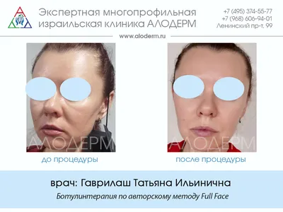 Dental Face - стоматологический тип старения лица | Интеллектуальная  косметология Face Clinic