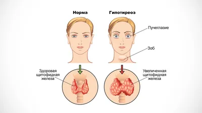 Гипотиреоз щитовидной железы — причины возникновения, симптомы заболевания,  диагностика и лечение болезни