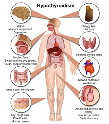 Гипотиреоз щитовидки: симптомы, лечение, признаки, у женщин, мужчин и детей